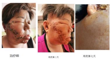 一种治疗带状疱疹的中药制剂及其制备方法——周桂兰