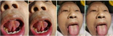 著名瑶医银疗推拿专家——周继辉