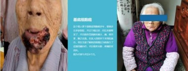 适温消融技术的临床应用