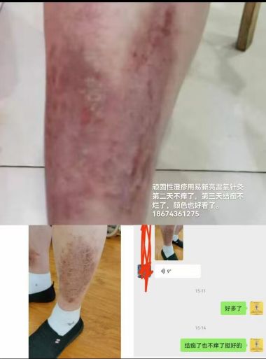 易新亮灵氧细胞针灸：开创百病断根快如闪电的创新疗法深度剖析！