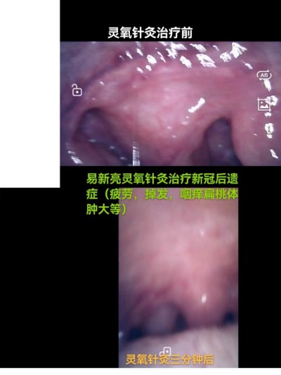 易新亮中医师：当中医针灸遇上现代科技，糖尿病与癌症、关节痛症的康复融合新路径