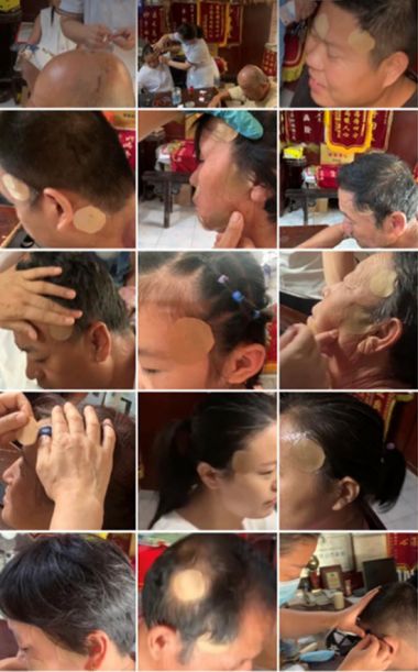 头痛病专家——李东兰