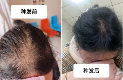 贯彻落实两会精神 特别报道新乡市毛囊加密.毛发再生.种植头发专家—郜义祥