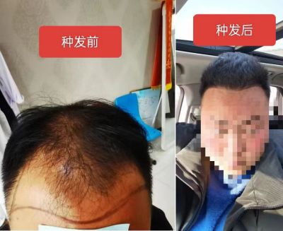 贯彻落实两会精神 特别报道新乡市毛囊加密.毛发再生.种植头发专家—郜义祥